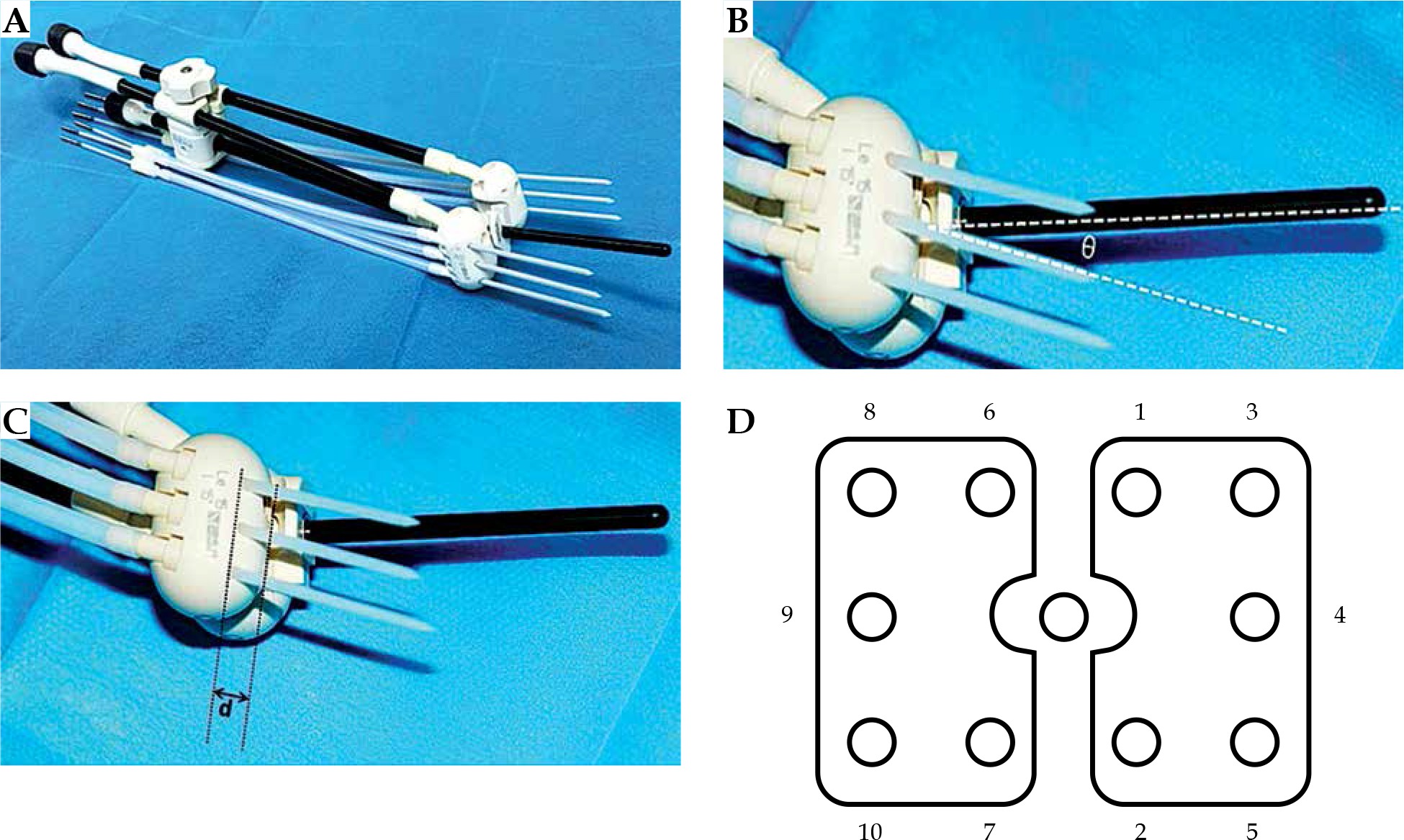 Application of transrectal ultrasound in guiding interstitial brachytherapy for advanced