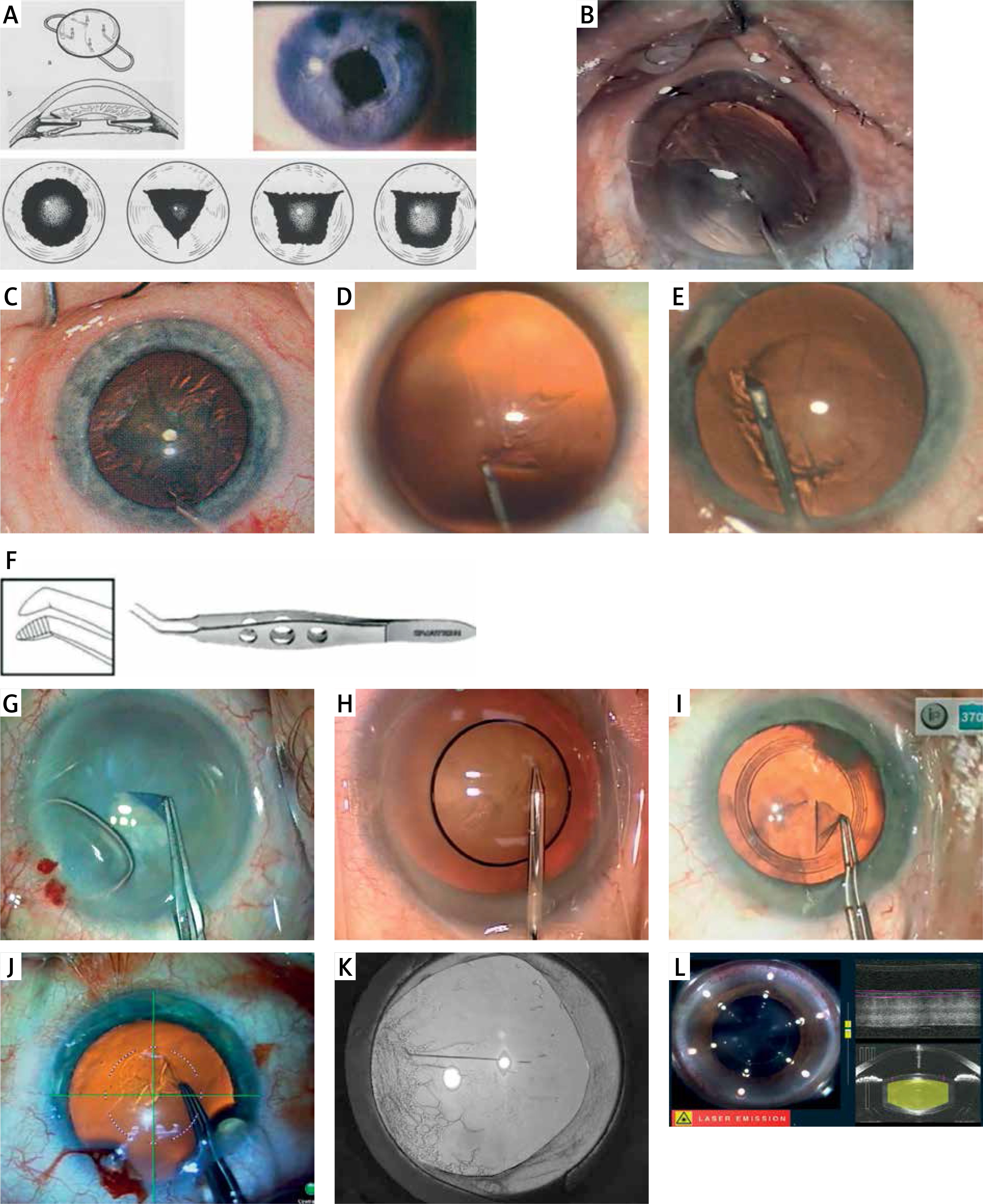 The evolution of the anterior capsulotomy